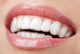 Closeup of smile with Invisalign trays in place
