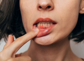 Woman pulling back her lip to reveal inflamed gums