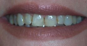 Closeup of discolored and damaged teeth