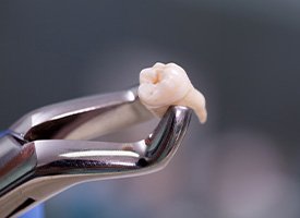 Dental forceps holding an extracted tooth