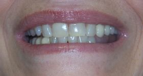 Closeup of yellowed unhealthy smile