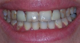 Closeup of smile with severe tooth decay and damage