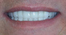 Closeup of smile with repaired side tooth