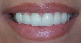 Closeup of perfectly aligned consistently sized teeth