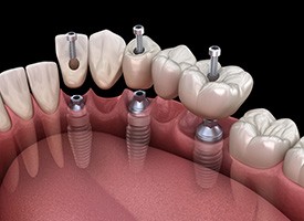 A traditional dental bridge next to a jaw mockup and a dental tool