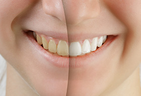 Closeup of smile half before and after whitening