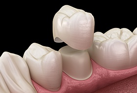 A 3D illustration of a dental crown being placed