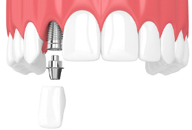 Model of a single dental implant.