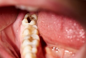 person with a cavity in a tooth